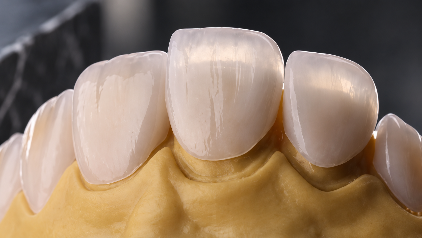 Veneers